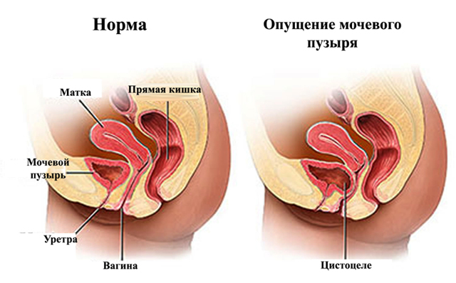 Опущение мочевого пузыря у женщин : что это такое, симптомы, лечение