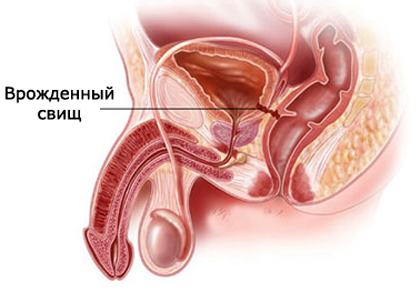 Болезни мочевого пузыря: симптомы, лечение у женщин и мужчин