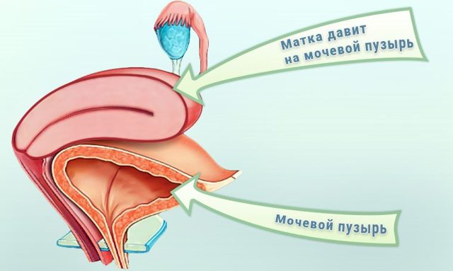 Шеечный цистит: симптомы и лечение у женщин