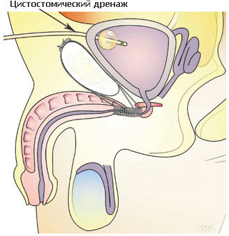 Троакарная цистостомия мочевого пузыря у мужчин: операция, уход