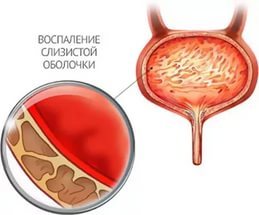 Моча с кровь у женщин (гематурия): причины, симптомы, диагностика, лечение